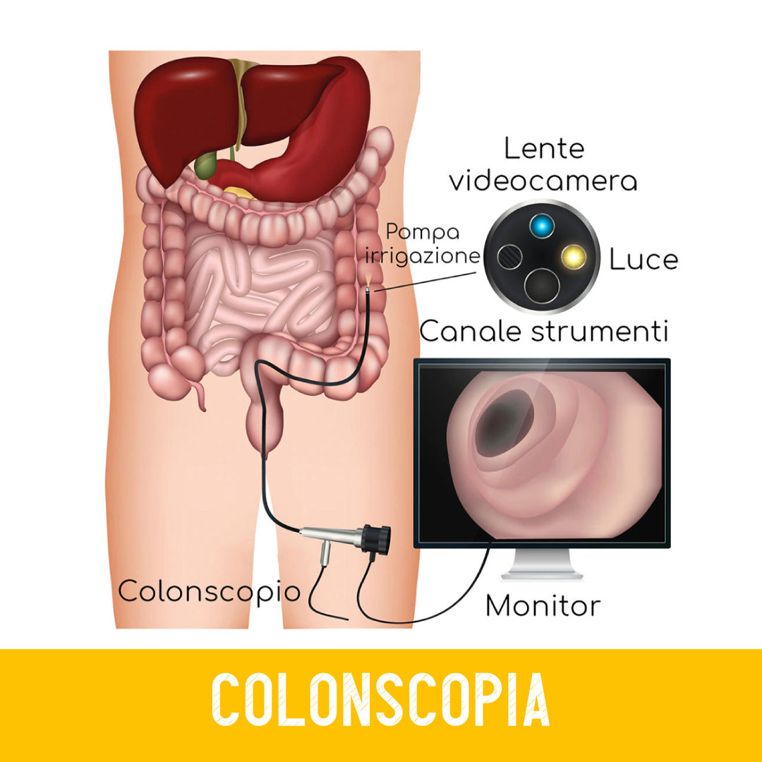 Colonscopia