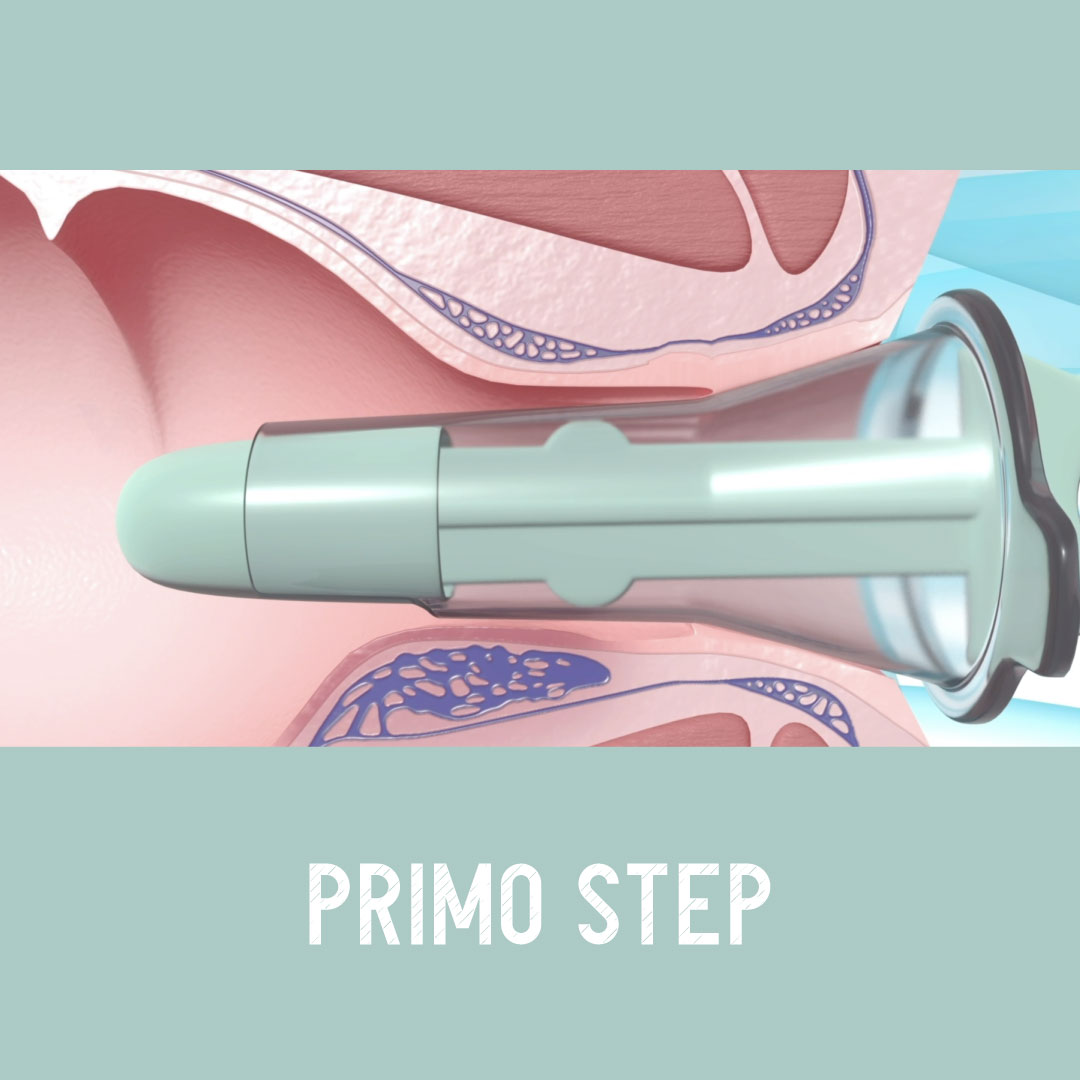 Exroid come funziona step 1