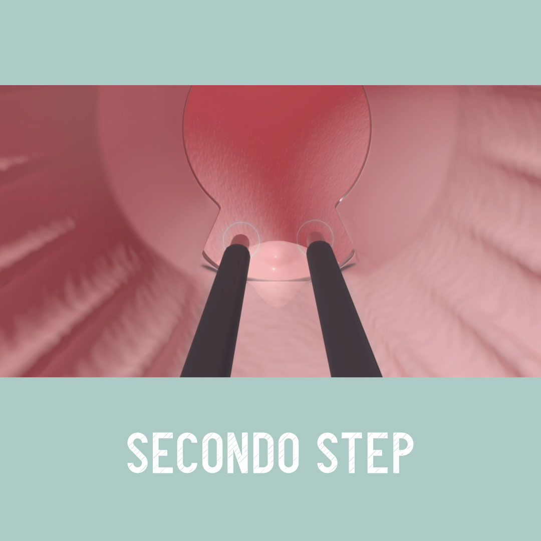 Exroid come funziona step 2