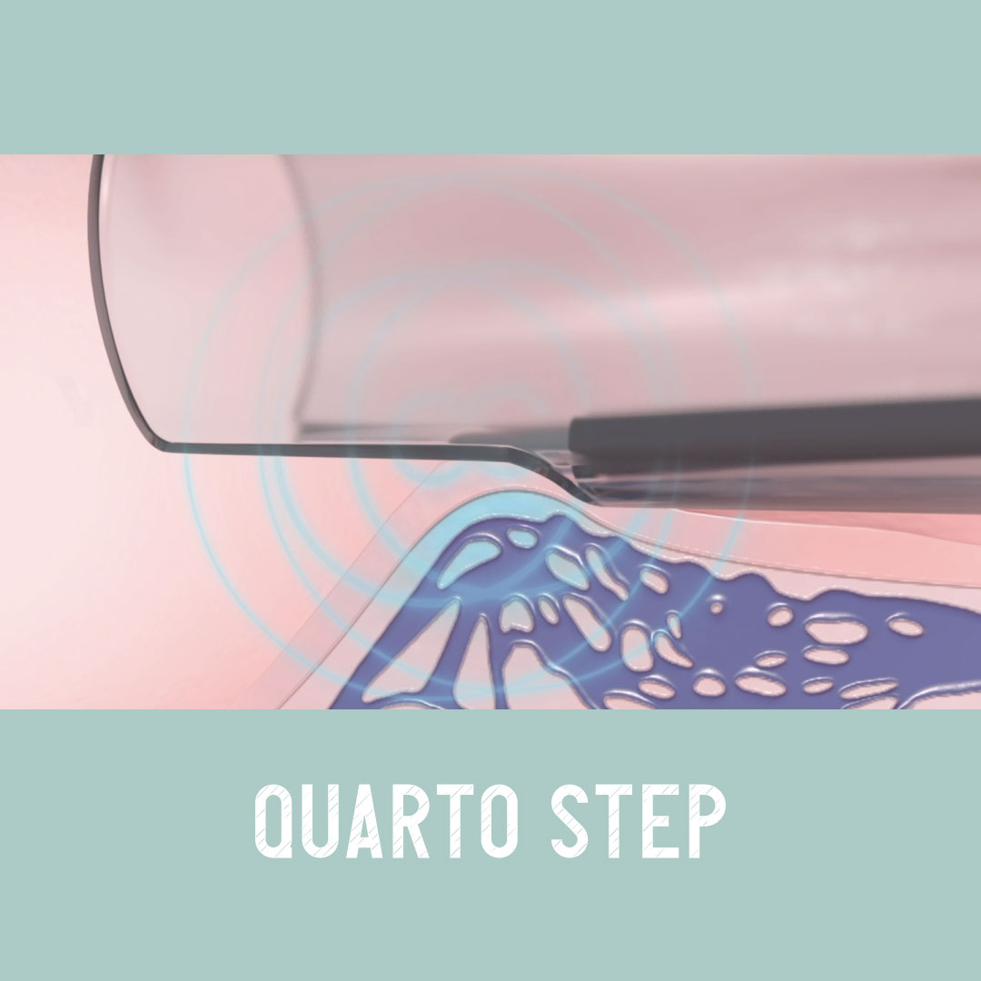 Exroid come funziona step 4