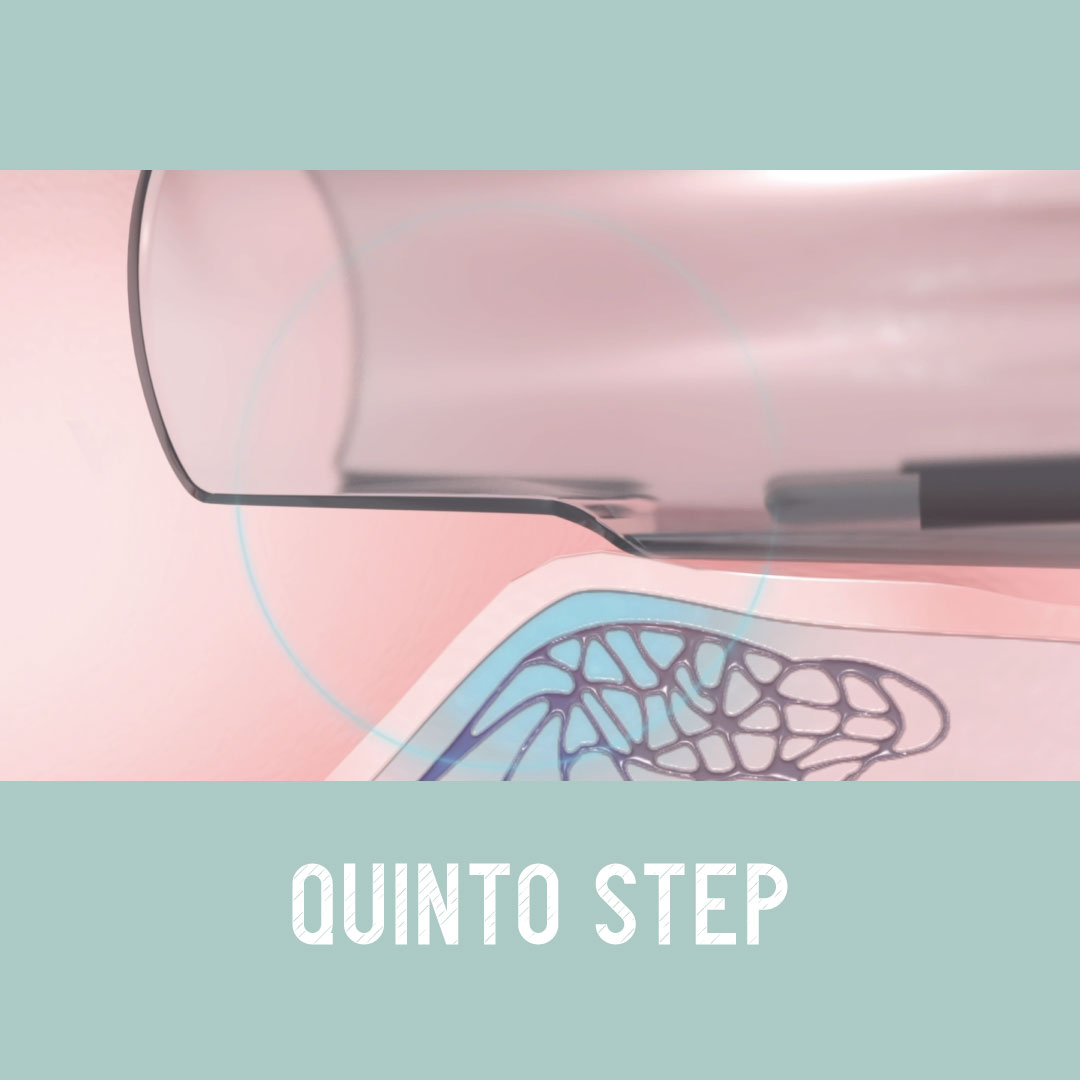 Exroid come funziona step 5