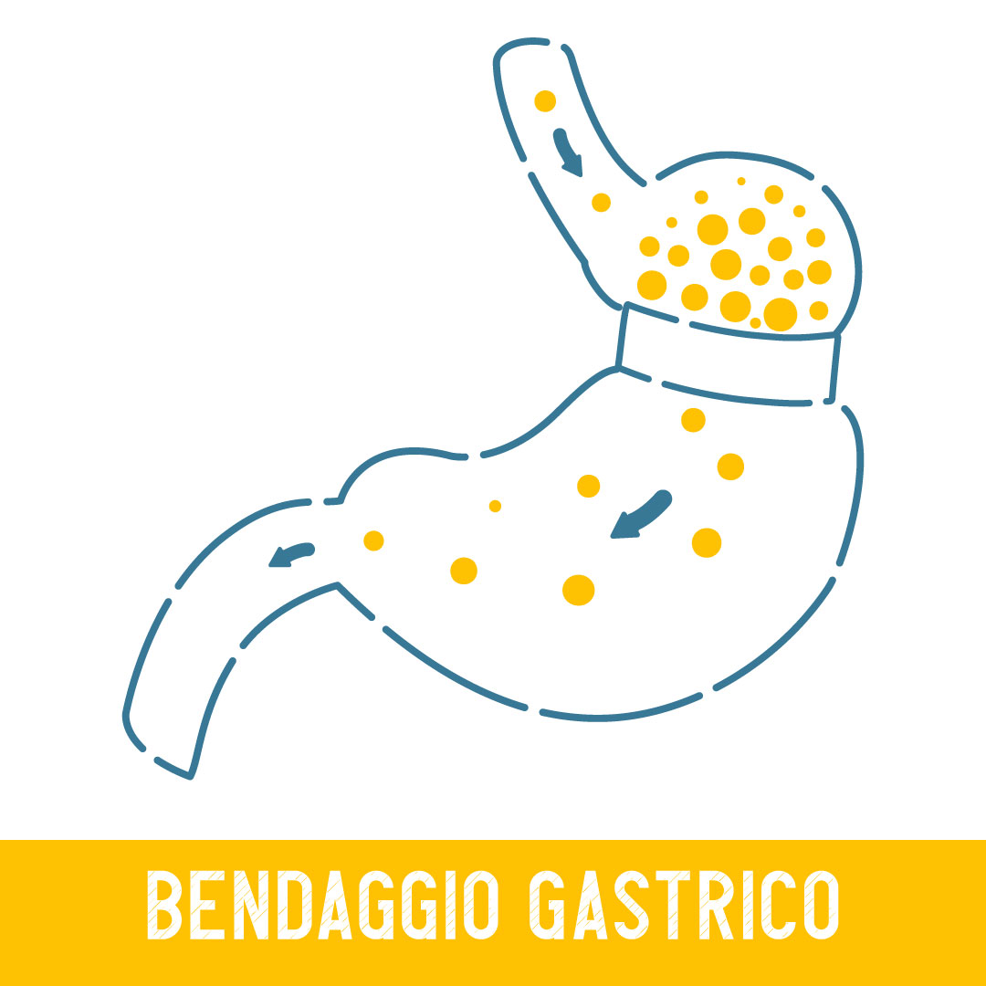bendaggio gastrico bendaggio gastrico
