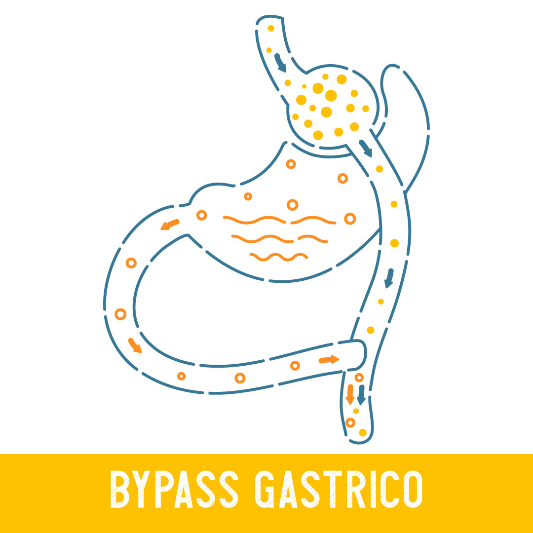 bypass gastrico bypass gastrico