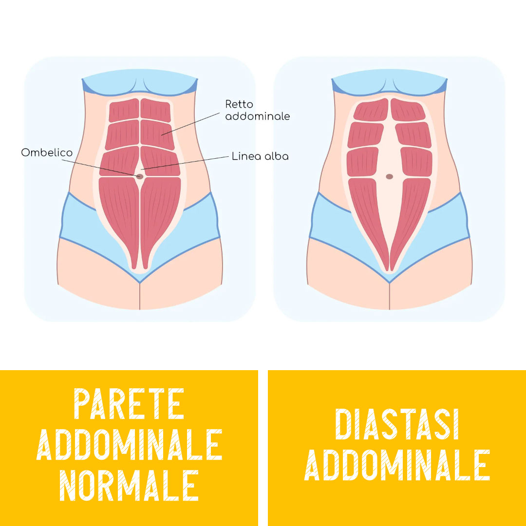 diastasi addominale diastasi addominale