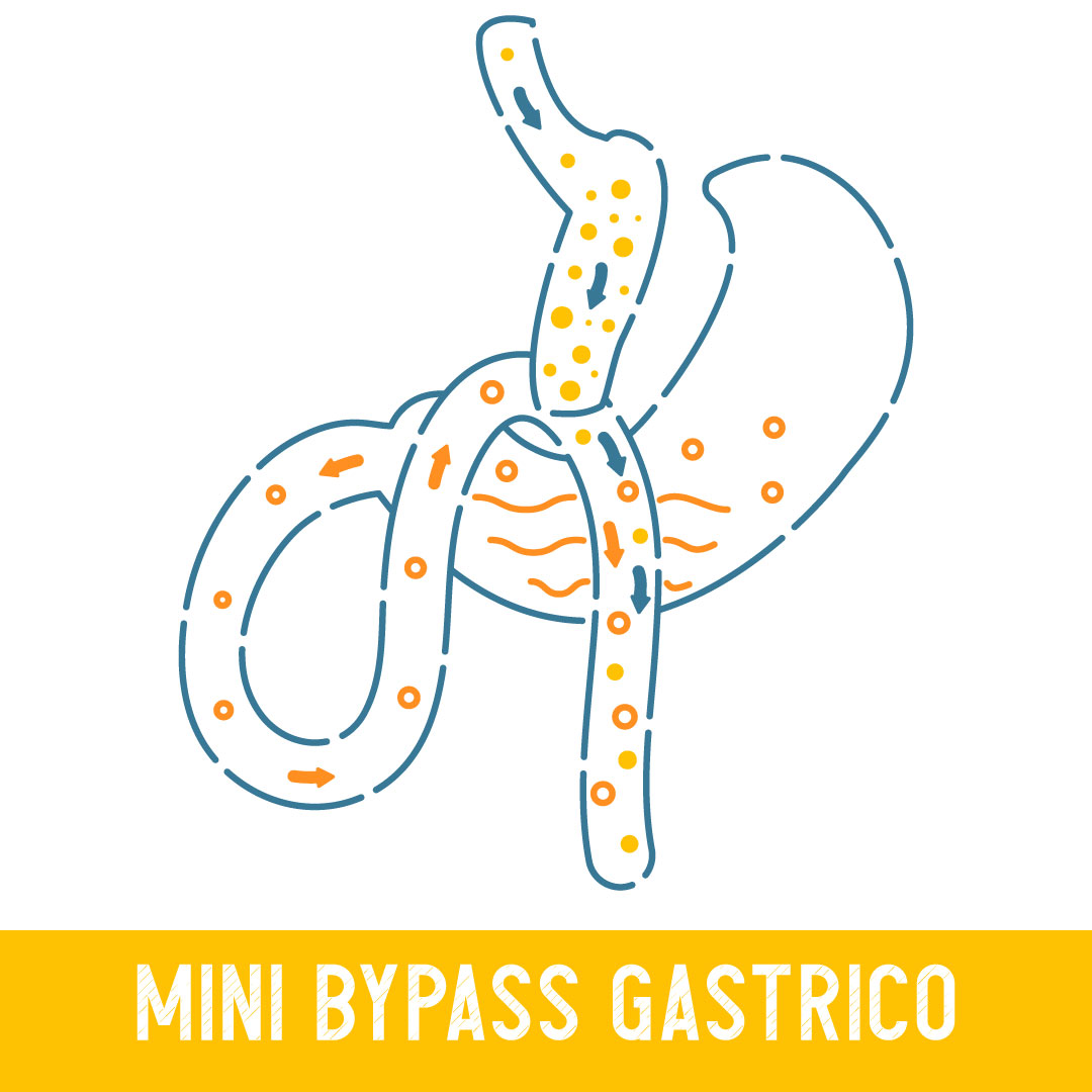 mini-bypass gastrico mini-bypass gastrico