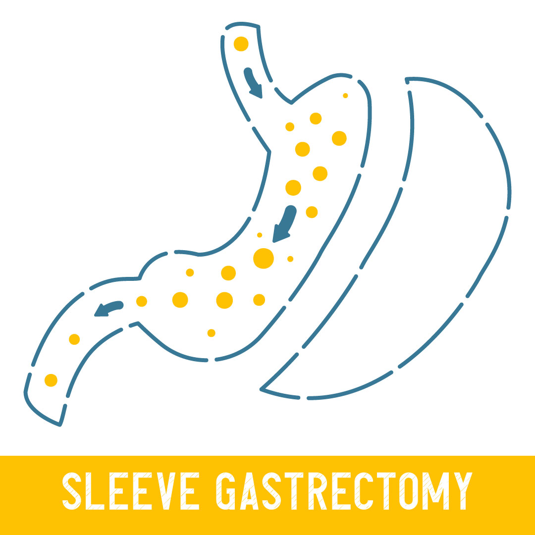 sleeve gastrectomy sleeve gastrectomy