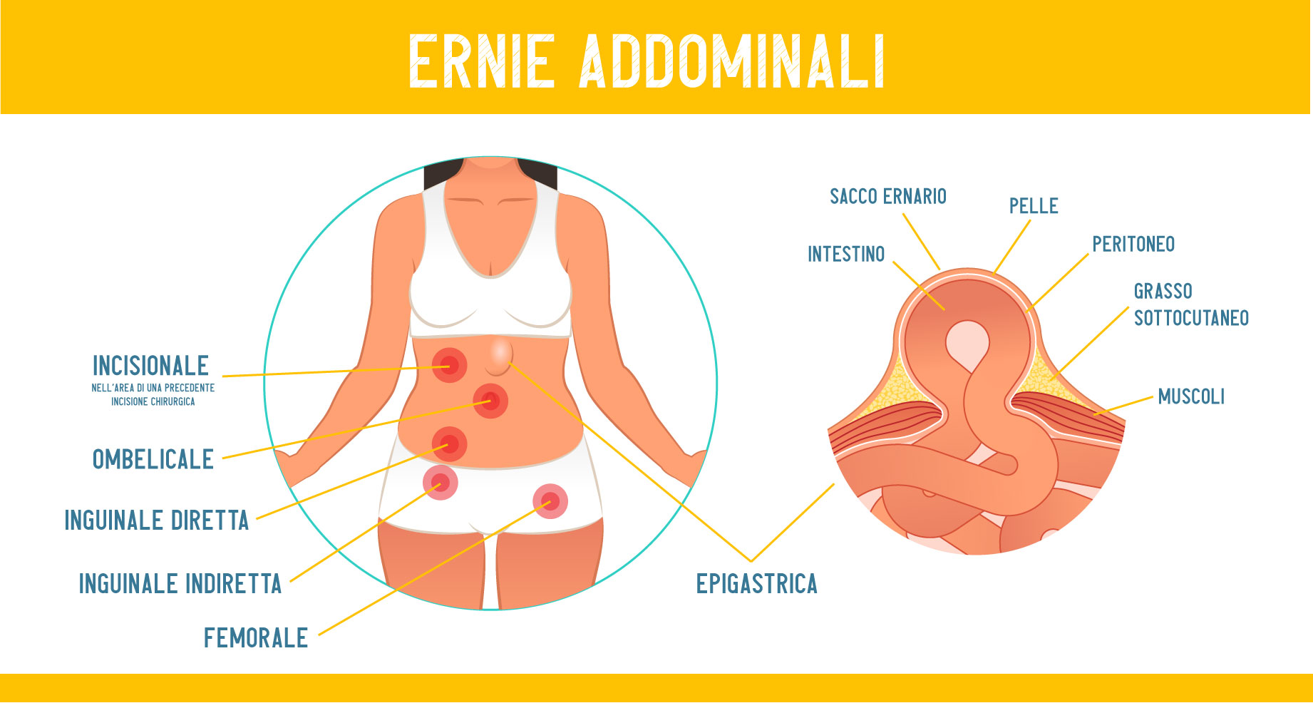tipologie di ernie addominali tipologie di ernie addominali