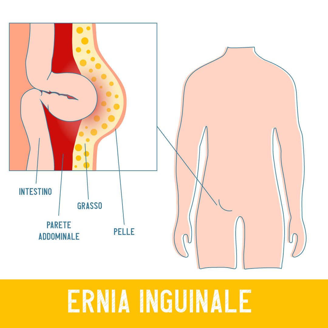 ernia inguinale