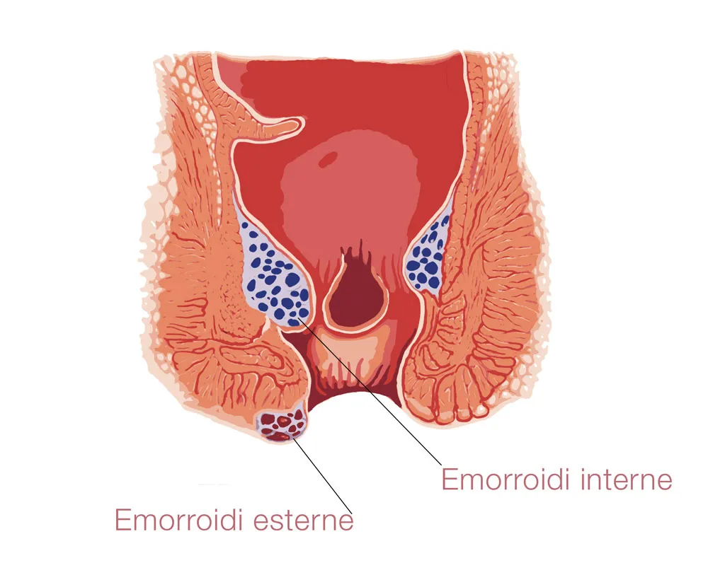emorroidi Emorroidi