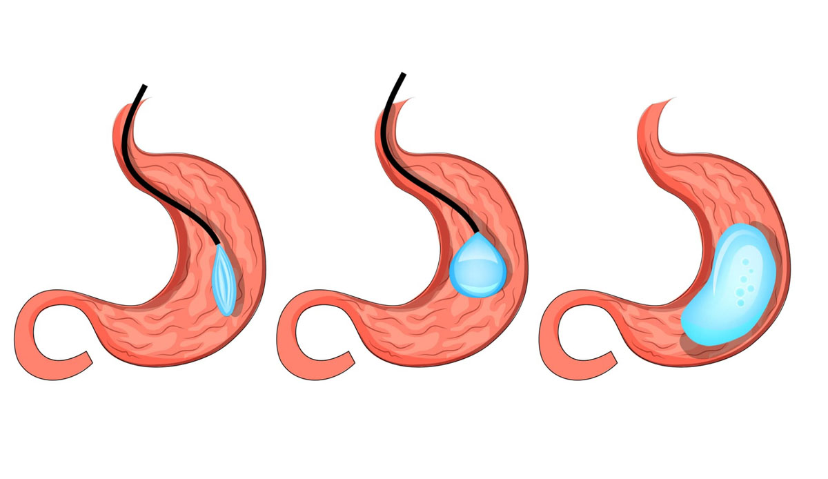 procedura palloncino intragastrico procedura palloncino intragastrico